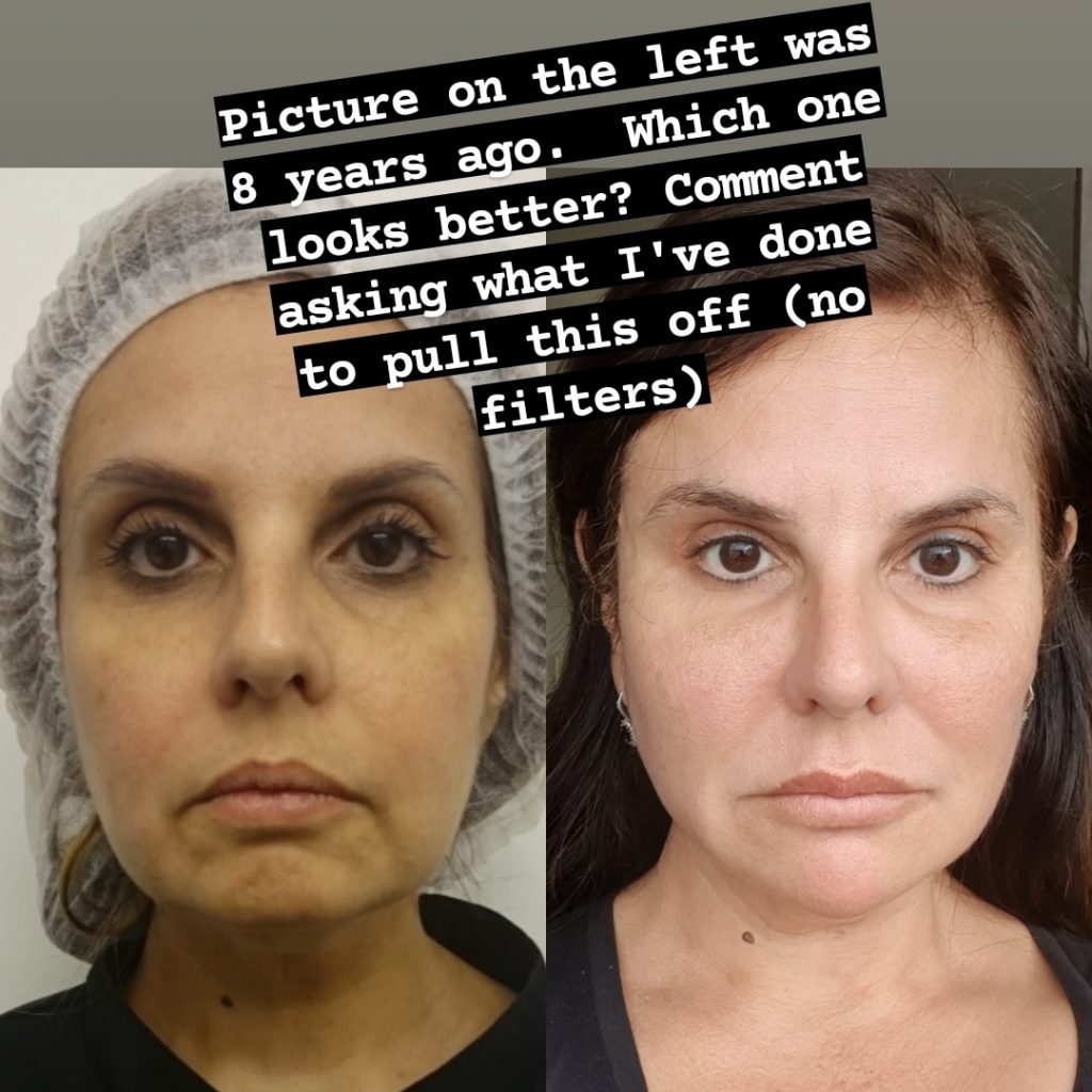 Dermalfiller Facelift London