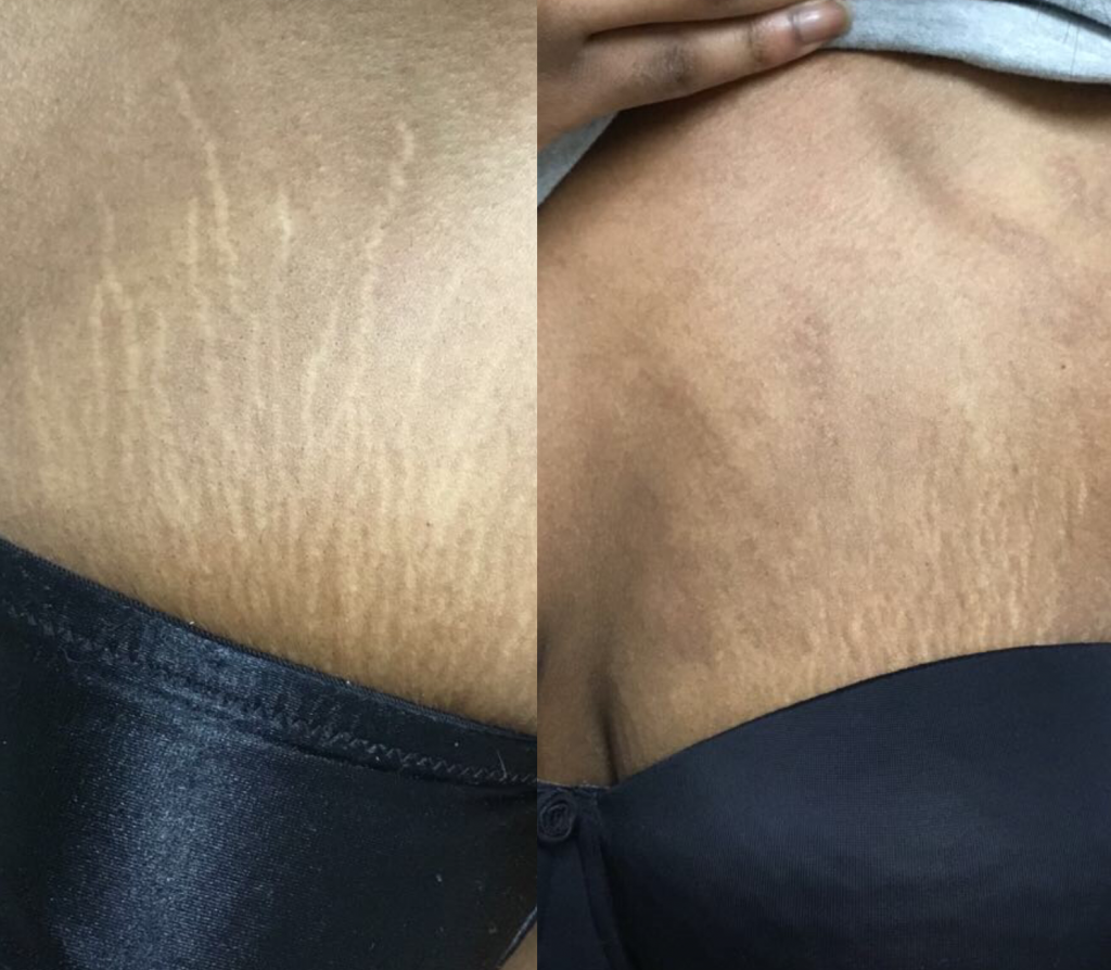 Stretch marks on breast are on black skin treatment before and after