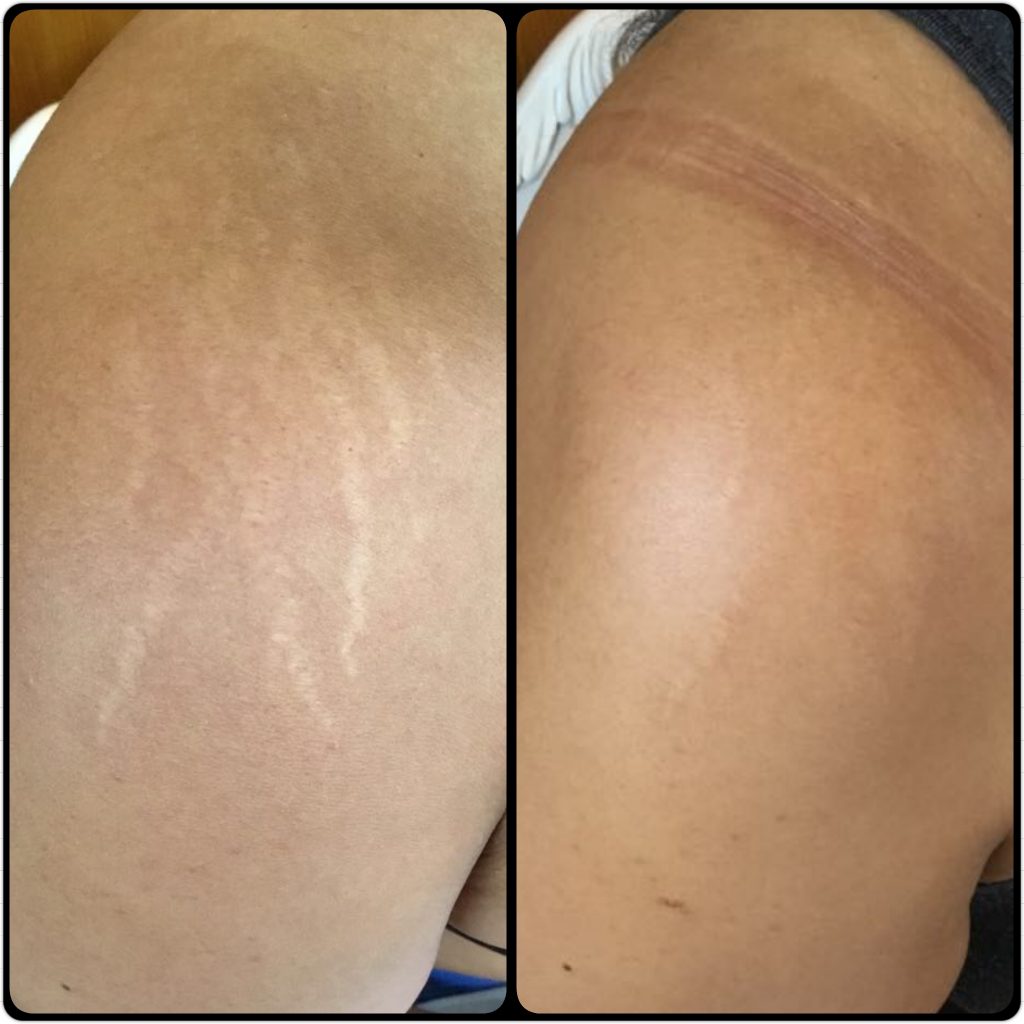 stretch marks on shoulders on black skin before and after photos.  stretch makrs treatment
