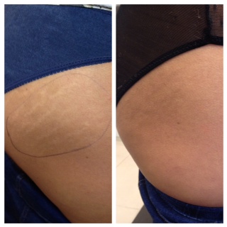 managing stretch marks in buttocks before and after