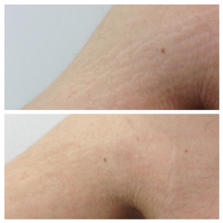managing stretch marks on arms before and after