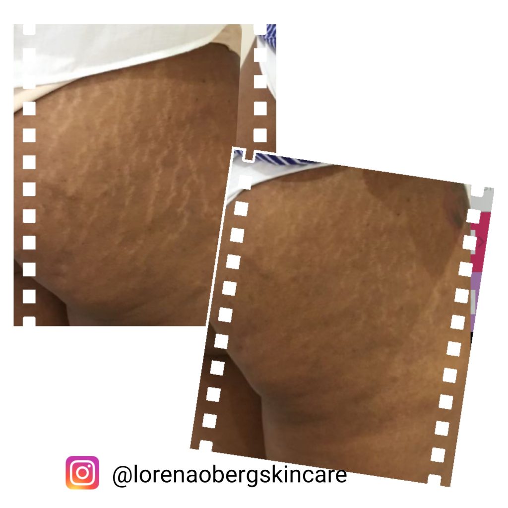 stretch marks removal on black skin before anda after