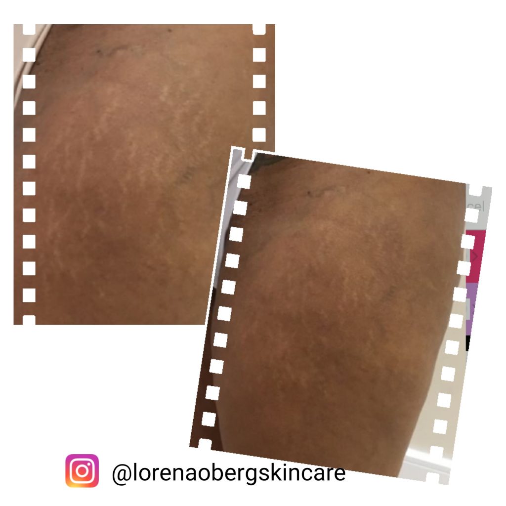 stretch marks treatment before and after managing stretch marks on dark skin