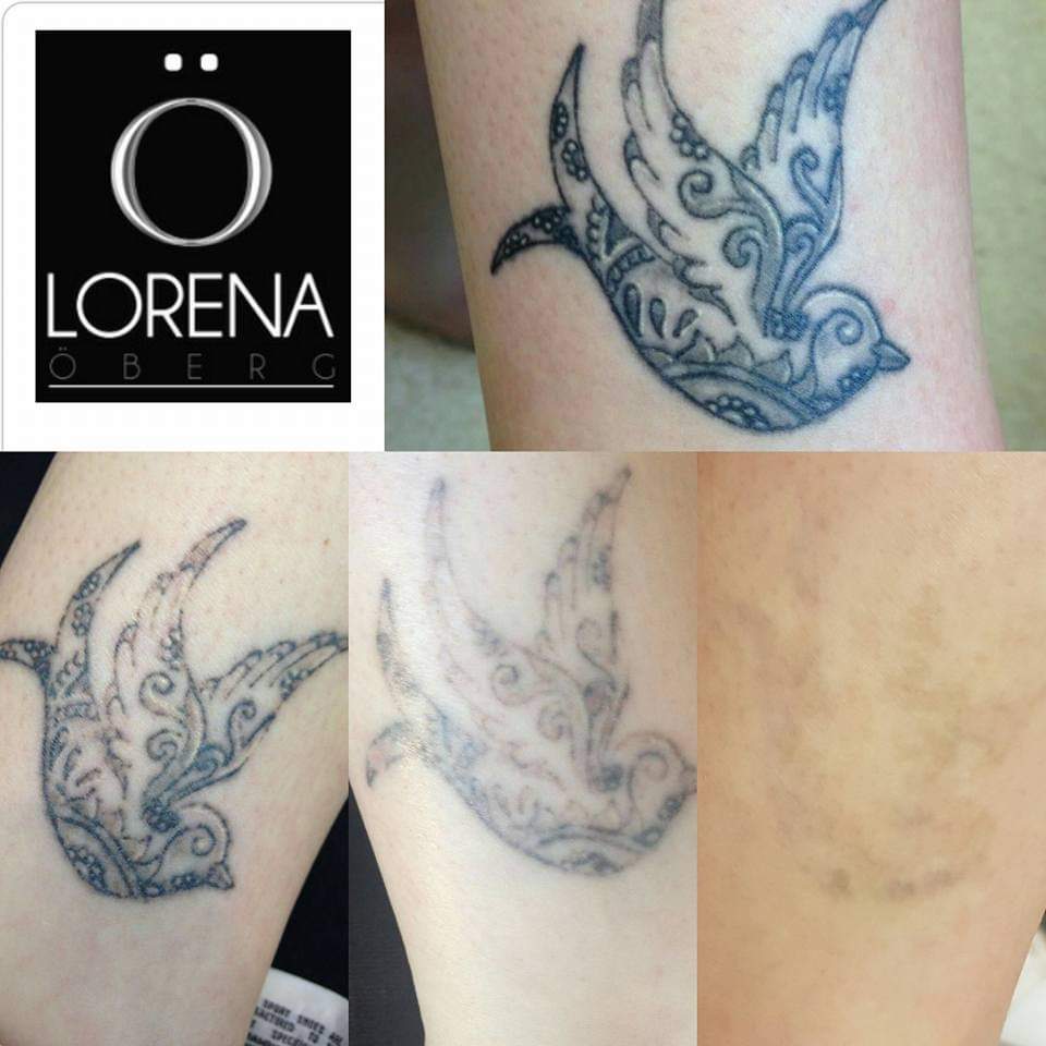 When to stop having tattoo removal