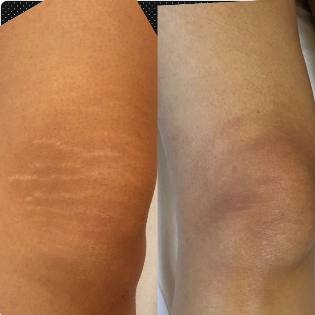 stretch marks on knees before and after dermaeraze treatment on black skin