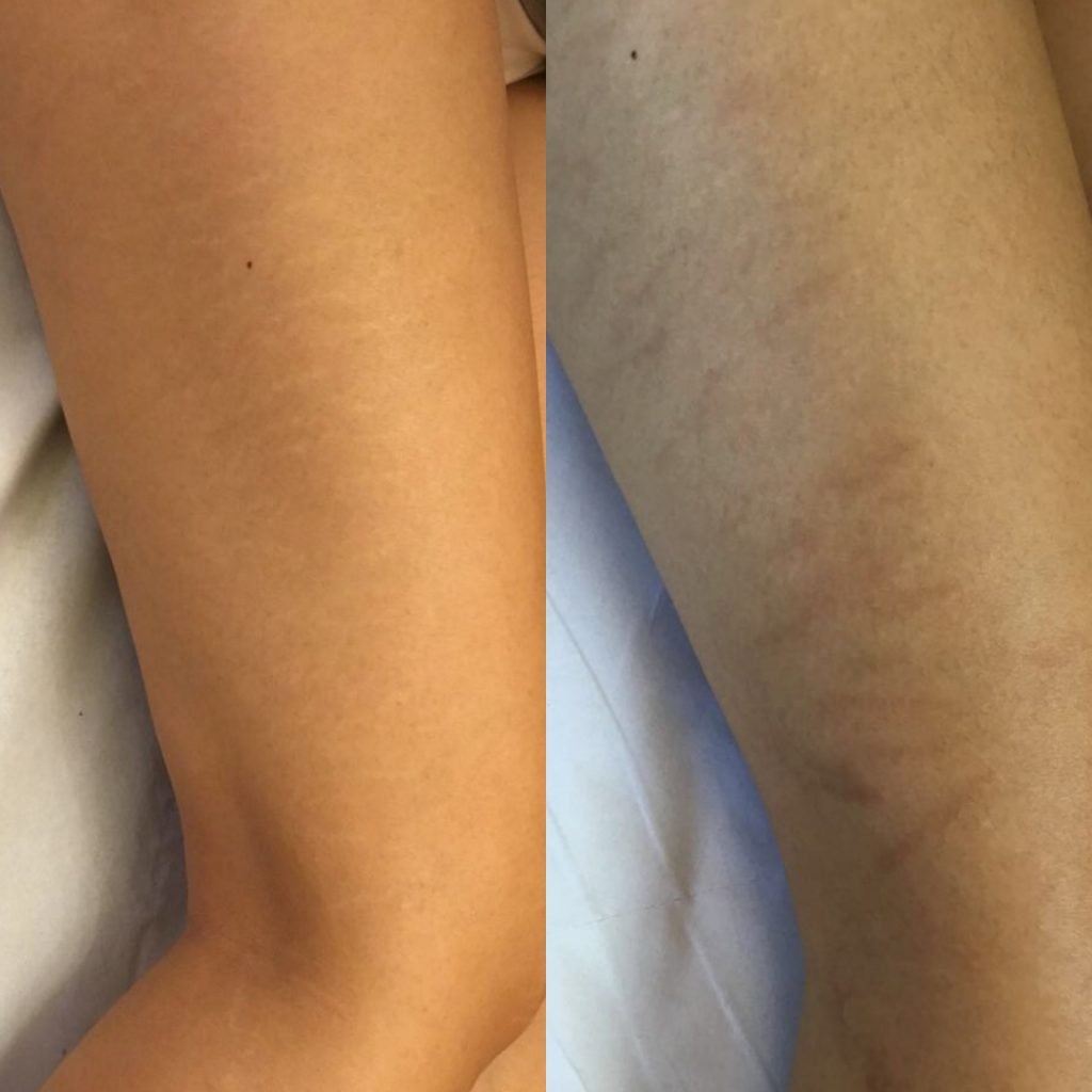 stretch marks solution and treatment on legs on asian skin before and after