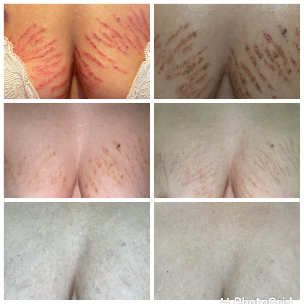 stretch marks removal on breast before and after 