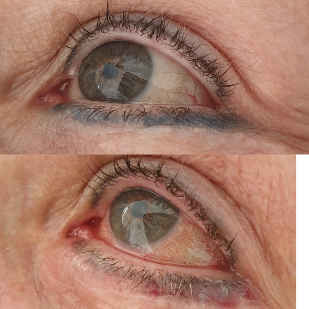 15 year old permanent makeup eyeliner removal